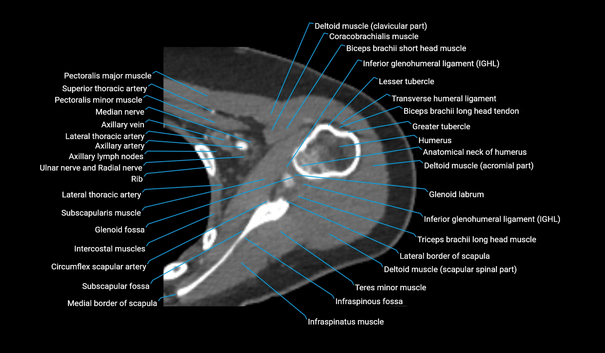 CT upper arm axial  cross sectional anatomy labelled radiology image -00110.webp
